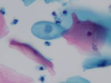 液基空泡细胞的鉴别（HPV感染？糖原溶解？核固缩？）