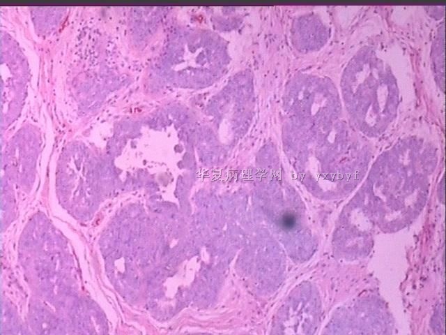 乳腺幼年型纤维腺瘤