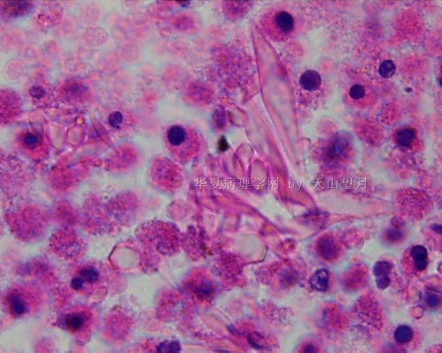 Charcot-Leyden crystals