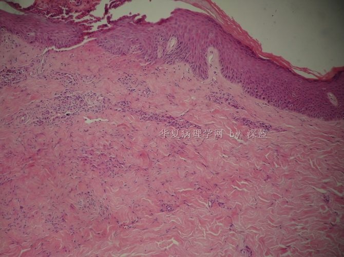 Molluscum contagiosum - Wikipedia