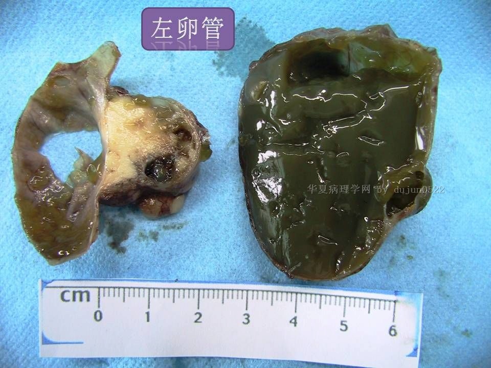 双侧卵巢肿物,累及双侧输卵管及子宫浆膜.