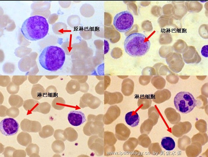 急性淋巴细胞白血病