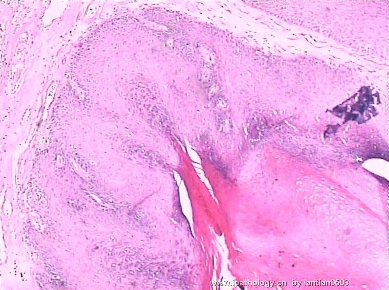 儿童阴茎疣状癌?