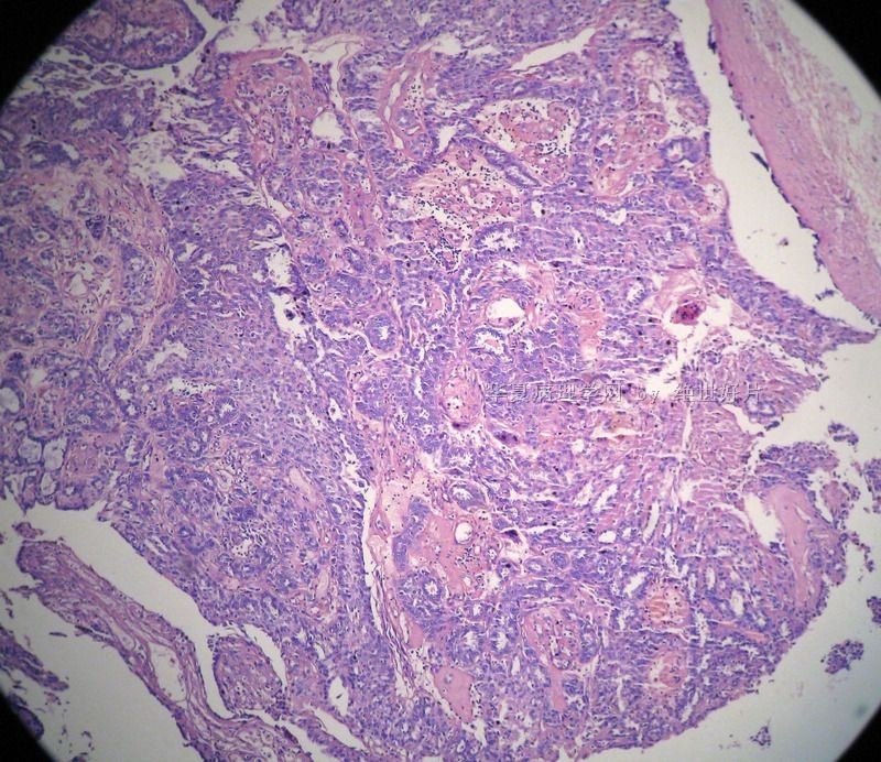 在一例导管内乳头状瘤切片中见到的