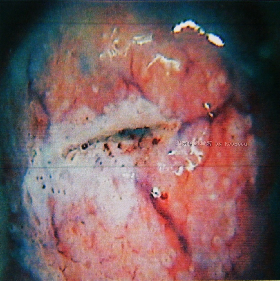 宫颈赘生物1例(p100219)