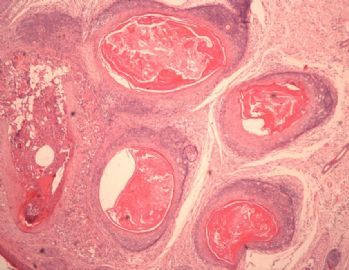1469-20110620毛发上皮瘤 - 专科病理>>皮肤病理 - 华夏病理网