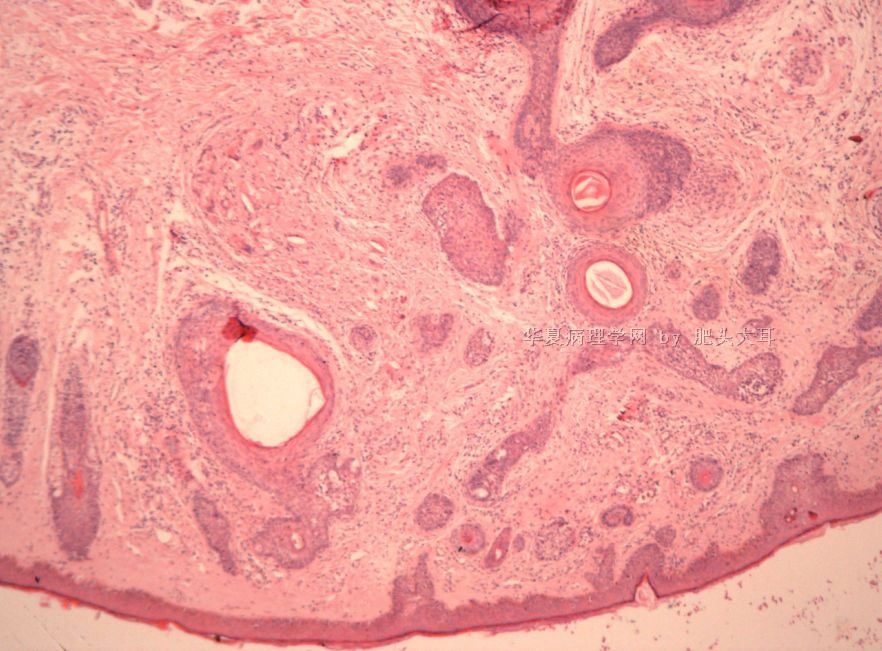 1469-20110620毛发上皮瘤 - 专科病理>>皮肤病理 - 华夏病理网